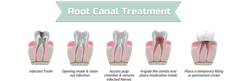 ما هي خطوات علاج جذور الأسنان؟